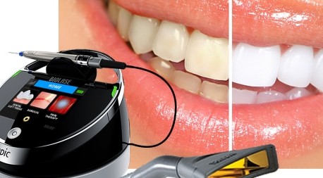 albire dentara cu laser